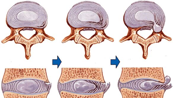 Rückenmarksverletzung bei Osteochondrose