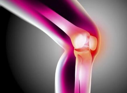 Deformierende Arthrose