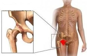 Die Gründe für die Entwicklung der Arthrose des Hüftgelenks