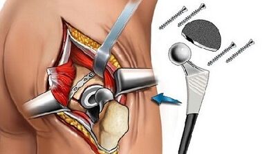 Endoprotetik für Hüft -Arthrose