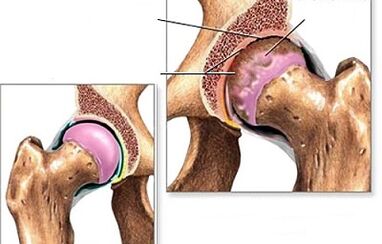 Hüft -Osteoarthritis -Diagnose