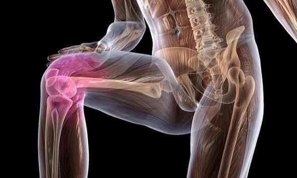 Anzeichen und Symptome der Arthrose des Kniegelenks
