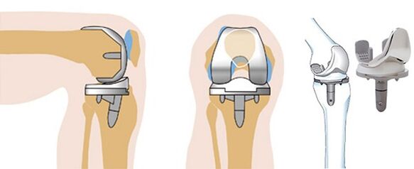 Endoprotischer Betrieb des Kniegelenks gegen Arthrose