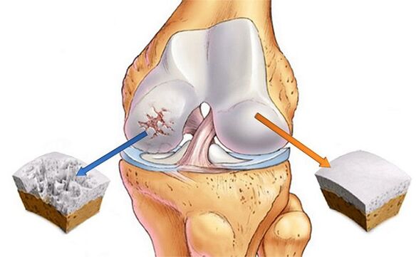 Standard und Abweichung für Arthrose des Kniegelenks
