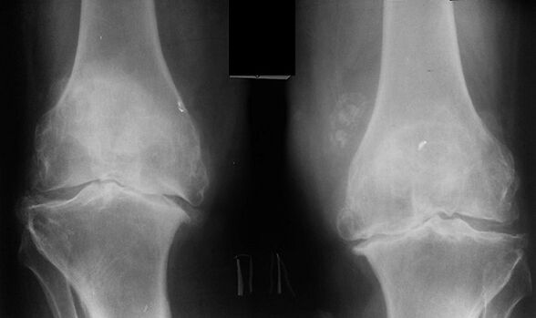 X -RAY, um die Arthrose des Kniegelenks zu diagnostizieren