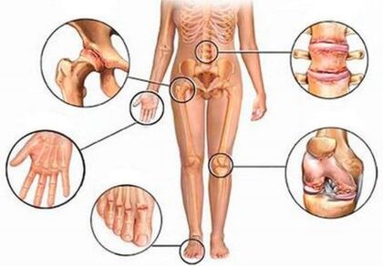 Arthritis und Arthrose mehrerer Gelenke