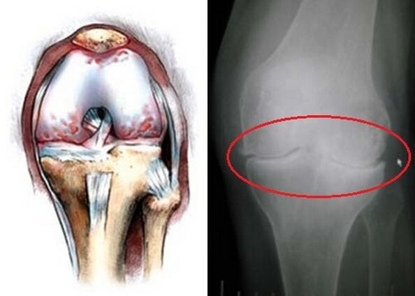 Die Verformung des Kniegelenks gegen Arthrose