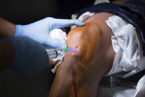 Injektionen in das Kniegelenk bei Arthrose. 
