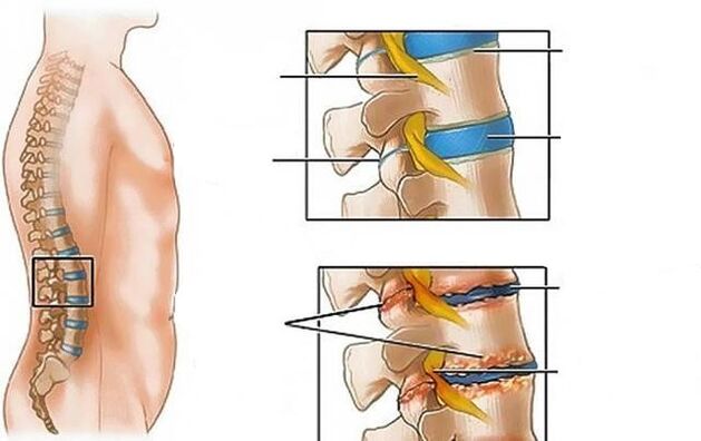 Osteochondrose der Lendenwirbelsäule verursacht Rückenschmerzen
